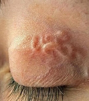 Достали паразита из века: в Запорожье обнаружили случай дирофиляриоза – что это и как уберечься